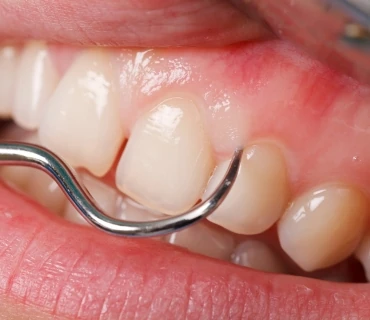 Diş Eti Tedavisi - Periodontoloji