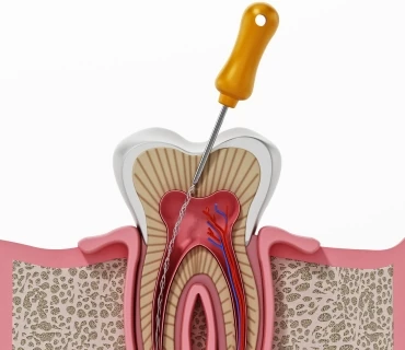 Kanal Tedavisi - Endodonti